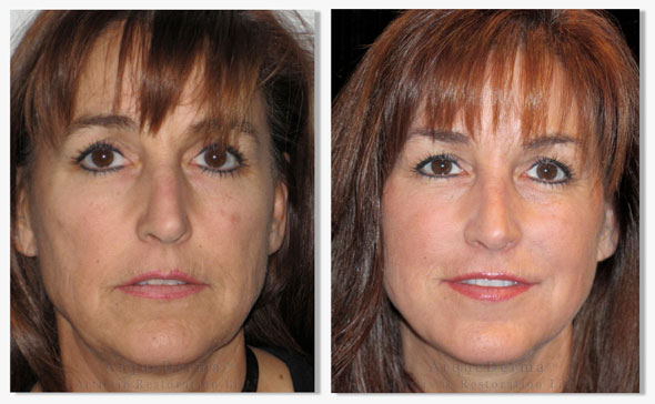The science, engineering & art behind ArqueDerma Artistic Restoration Lift