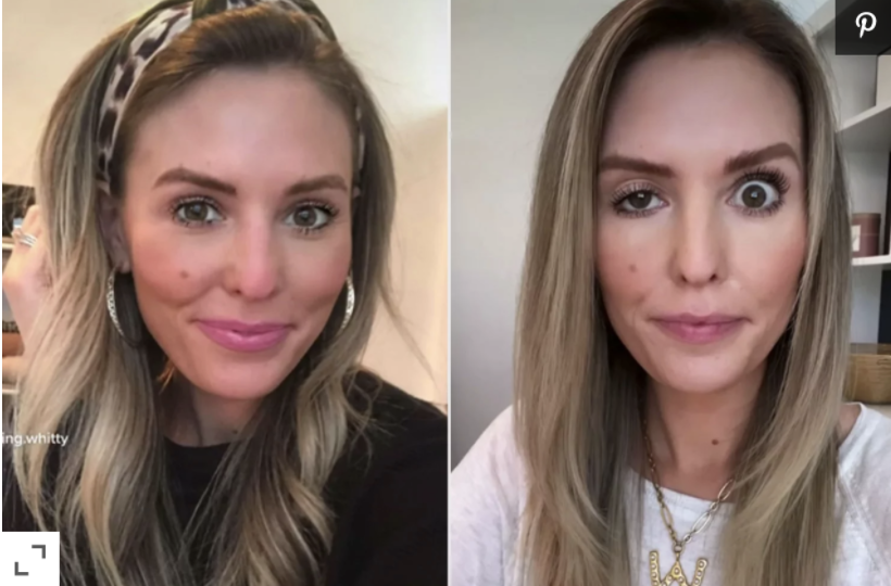 Botox Gone Wrong: How To Prevent This With Dr. Busso